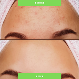 Organic Two-Step Anti-Acne Facial System = For WOMEN Onyx Skin Care Line